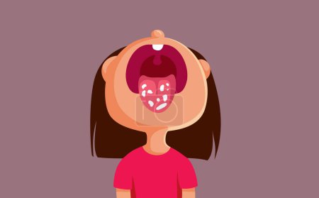 Illustration for Child with White Fungal Infection on her Tongue Vector Cartoon - Royalty Free Image