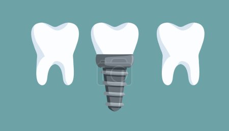 Vektorzeichnung von Zahnimplantaten zwischen anderen Zähnen