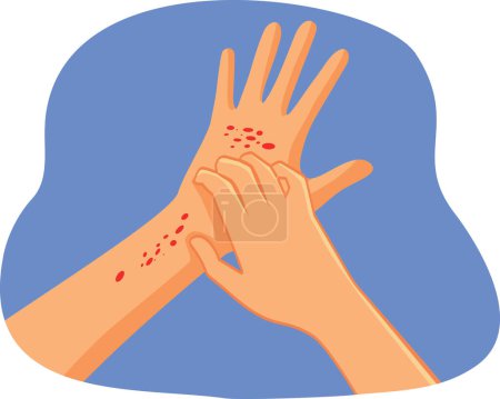 Hands Scratching Having Eczema Problems Vector Illustration