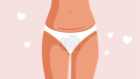 Woman Proudly Showing Her C Section Vector Cartoon Illustration