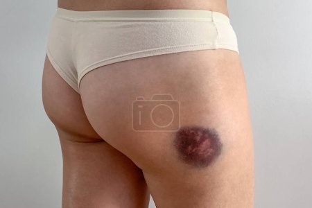 Téléchargez les photos : Hématome sur la peau de la jambe à la suite d'un coup à la jambe d'une femme gros plan - en image libre de droit