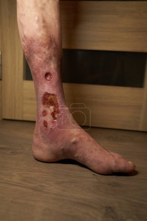 Gros plan des ulcères trophiques sur la jambe                          