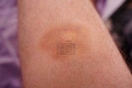 Photo for Ecchymosis bruise on leg bleeding under the skin due to trauma. - Royalty Free Image