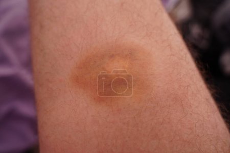Photo for Ecchymosis bruise on leg bleeding under the skin due to trauma. - Royalty Free Image