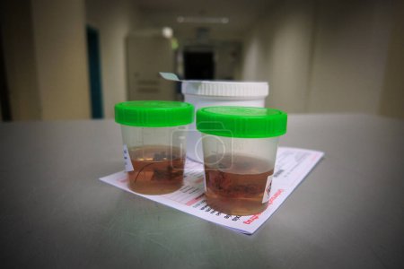 Foto de Las muestras de tejido se colocan en formalina para su posterior examen por un patólogo en el hospital. - Imagen libre de derechos