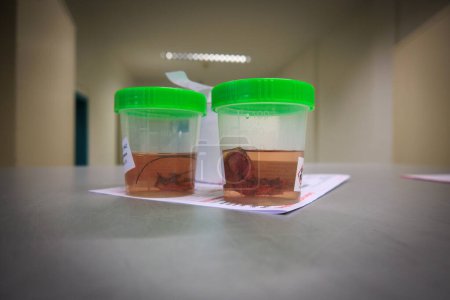 Foto de Las muestras de tejido se colocan en formalina para su posterior examen por un patólogo en el hospital. - Imagen libre de derechos