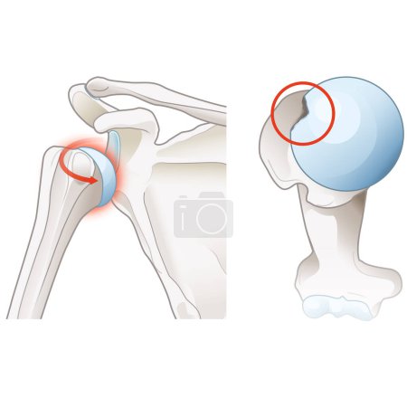 Subacromial bursitis is inflammation of the bursa in the shoulder, causing pain, swelling, and reduced mobility, often associated with rotator cuff issues or overuse injuries.