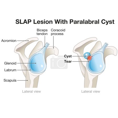 Un kyste paralabral de lésion SLAP dans l'épaule est une déchirure dans le labre accompagnée d'un kyste, causant souvent de la douleur, de l'instabilité et des limitations fonctionnelles, nécessitant généralement une intervention chirurgicale pour le traitement.