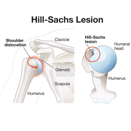 Foto de Una lesión de Hill-Sachs es un defecto similar a un divot en la cabeza humeral, a menudo como resultado de la dislocación del hombro. Puede contribuir a la inestabilidad y rango limitado de movimiento en la articulación. - Imagen libre de derechos