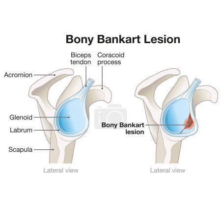 Une lésion de Bony Bankart à l'épaule implique une fracture de la jante glénoïde antérieure, souvent due à une luxation, entraînant une instabilité et nécessitant une réparation chirurgicale pour restaurer la stabilité.