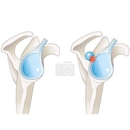 Photo for A SLAP lesion paralabral cyst in the shoulder is a tear in the labrum accompanied by a cyst, often causing pain, instability, and functional limitations, typically requiring surgical intervention for treatment. - Royalty Free Image