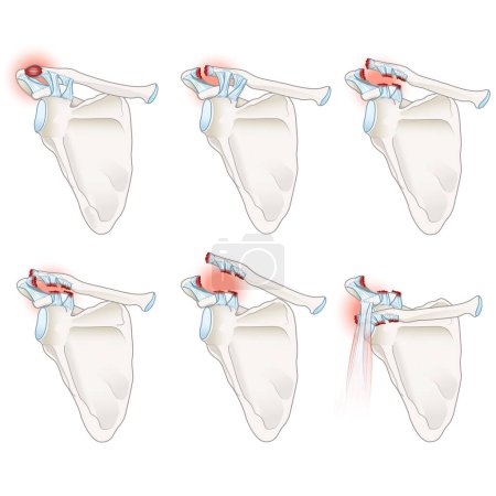 La separación de la articulación AC es una lesión en el hombro que involucra daño del ligamento en la articulación acromioclavicular. Causa dolor, hinchazón y posible deformidad, con opciones de tratamiento que van desde enfoques conservadores hasta la intervención quirúrgica basada en el sev.
