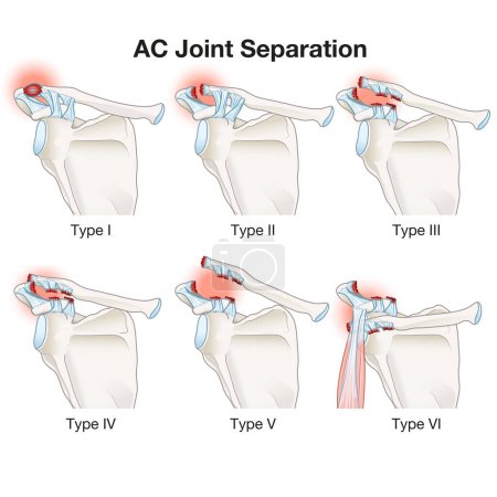 La separación de la articulación AC es una lesión en el hombro que involucra daño del ligamento en la articulación acromioclavicular. Causa dolor, hinchazón y posible deformidad, con opciones de tratamiento que van desde enfoques conservadores hasta la intervención quirúrgica basada en el sev.