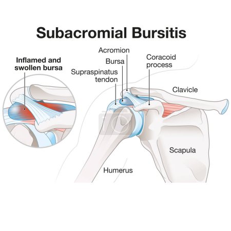 La bursitis subacromial es la inflamación de la bursa en el hombro, causando dolor, hinchazón y movilidad reducida, a menudo asociada con problemas del manguito rotador o lesiones por uso excesivo..