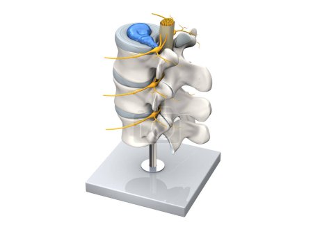 Foto de Ilustración que muestra el modelo de una hernia discal de la columna lumbar, estenosis, disco resbalado. Ilustración 3D - Imagen libre de derechos