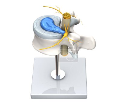 Illustration showing model of a herniated disc of the lumbar spine, stenosis, slipped disc. 3D Illustration
