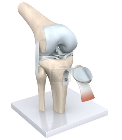 Photo for The knee joint, a complex hinge structure, connects the thigh bone (femur) to the shin bone (tibia), cushioned by cartilage, enabling flexion, extension, and slight rotation. - Royalty Free Image