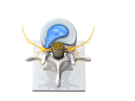 Ilustración que muestra el modelo de una hernia discal de la columna lumbar, estenosis, disco resbalado. Ilustración 3D