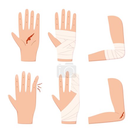 Illustration for Set of Hand, Palm, Elbow, Finger and Arm Injury with Blood and Bandage Isolated on White Background. First Aid, Health Care, Limb Trauma Treatment, Rehabilitation Concept. Cartoon Vector Illustration - Royalty Free Image