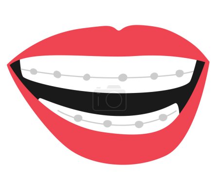 Illustration for Mouth With Braces Features A Beautiful Smile Adorned With Metal Brackets And Wires That Straighten Teeth And Improve Dental Health Isolated On White Background. Cartoon Vector Illustration - Royalty Free Image