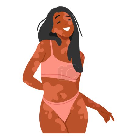 Illustration for Confident, Happy Woman With Vitiligo Embraces Her Unique Beauty, Radiating Joy In A Stylish Bikini. Female Character Challenging Conventional Standards And Celebrating Diversity With Pride - Royalty Free Image