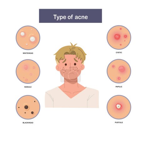 Illustration for Infographic of Type of acne, sad and worried man with acne. Flat vector illustration - Royalty Free Image