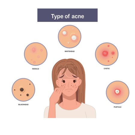 Illustration for Infographic of Type of acne, sad and worried woman with acne. Flat vector illustration - Royalty Free Image