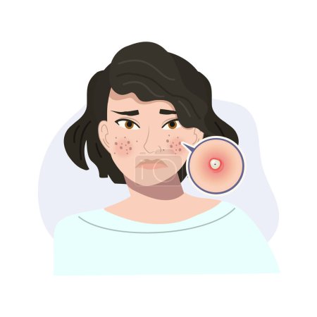 Illustration for Portrait of Stressed Female with Troubled Skin. Acne, Pustule Skin Close Up. Flat vector cartoon illustration - Royalty Free Image