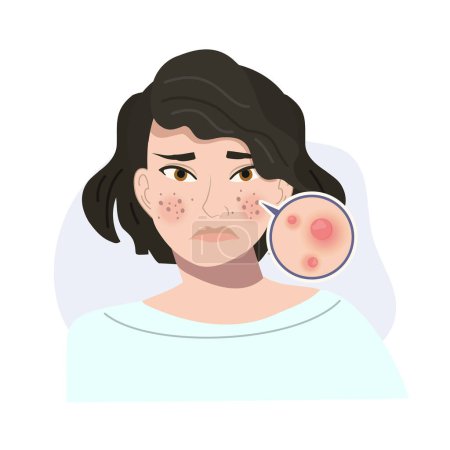 Illustration for Portrait of Stressed Female with Troubled Skin. Acne, Papule Skin Close Up. Flat vector cartoon illustration - Royalty Free Image