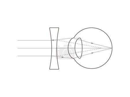 Lente de ojo cóncavo. ilustración científica vectorial.