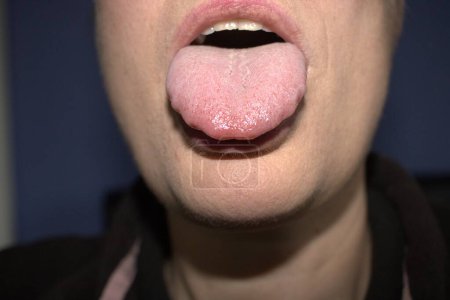 Foto de Inflamación de la lengua blanca agrandada con ondulación ondulada bordes festoneados (nombre médico es macroglosia) y se encuentran protuberancias - Imagen libre de derechos