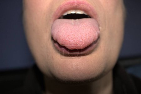 Téléchargez les photos : Gonflement de la langue blanche élargie avec ondulation ondulée bords festonnés (nom médical est macroglossia) et bosses de mensonge - en image libre de droit