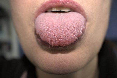 geschwollene, vergrößerte, weiße Zunge mit welligen, wellenförmigen überbuchten Rändern (medizinischer Name ist Makroglossie) und Unebenheiten