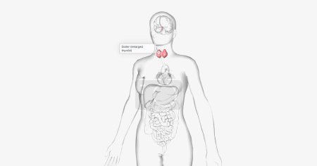 Téléchargez les photos : Hashimoto's thyroiditis is an autoimmune condition characterized by inadequate production of thyroid hormones. 3D rendering - en image libre de droit