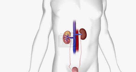 Téléchargez les photos : The Kidney Cancer, Stage II 3D rendering - en image libre de droit