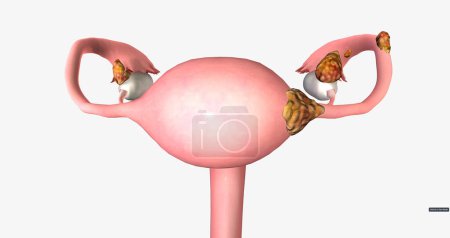 Stage II ovarian tumor has spread to nearby organs, such as the uterus and the body of the fallopian tubes. 3D rendering