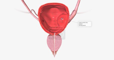 Foto de A ureterocele is a congenital defect of the ureter, the tube that carries urine from the kidney to the urinary bladder. 3D rendering - Imagen libre de derechos