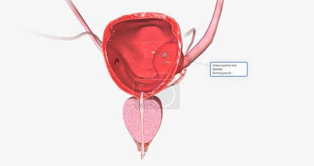 Foto de A ureterocele is a congenital defect of the ureter, the tube that carries urine from the kidney to the urinary bladder. 3D rendering - Imagen libre de derechos