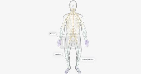 Téléchargez les photos : Guillain Barre syndrome is a rare disorder in which your body's immune system attacks your nerves. 3D rendering - en image libre de droit