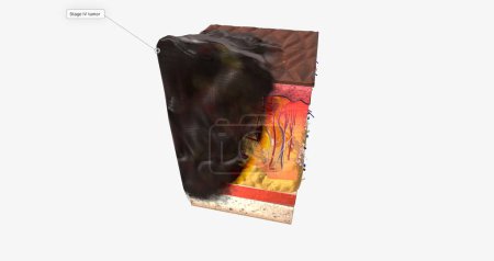 Photo for The In Stage III ALM Acral Lentiginous Melanoma 3D rendering - Royalty Free Image