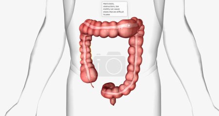 Photo for Chronic idiopathic constipation is a gastrointestinal condition characterized by long-term difficulties passing stool. 3D rendering - Royalty Free Image