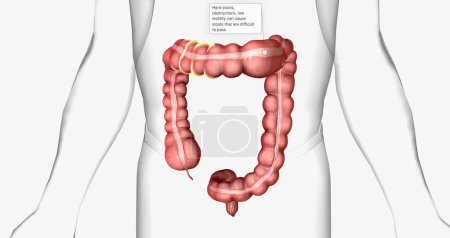 Chronic idiopathic constipation is a gastrointestinal condition characterized by long-term difficulties passing stool. 3D rendering