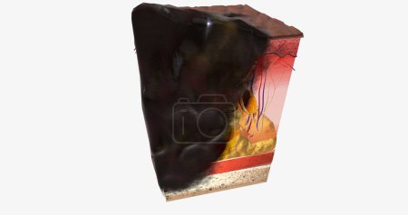 Photo for The In Stage III ALM Acral Lentiginous Melanoma 3D rendering - Royalty Free Image