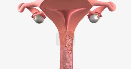 In stage II, the cancer has invaded the upper part of the vagina and tissue near the uterus called the parametrium.3D rendering