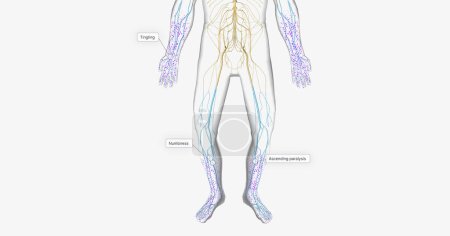 Téléchargez les photos : Guillain Barre syndrome is a rare disorder in which your body's immune system attacks your nerves. 3D rendering - en image libre de droit