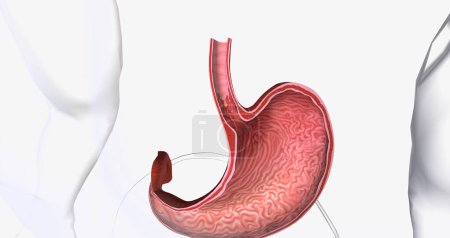 Photo for Barretts esophagus is a condition in which the tissue lining the esophagus is replaced by tissue that is similar to the intestinal lining. 3D rendering - Royalty Free Image