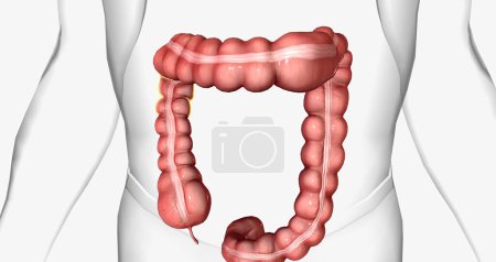 Photo for Chronic idiopathic constipation is a gastrointestinal condition characterized by long-term difficulties passing stool. 3D rendering - Royalty Free Image