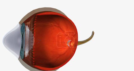 Téléchargez les photos : Keratoconus is an eye disease that affects the structure of the cornea. 3D rendering - en image libre de droit