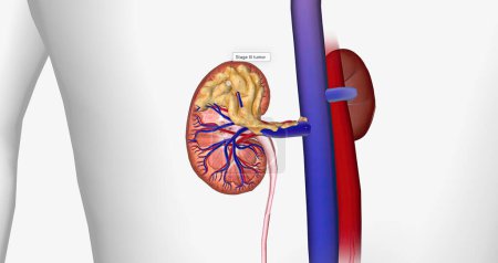 Photo for The Kidney Cancer, Stage III 3D rendering - Royalty Free Image