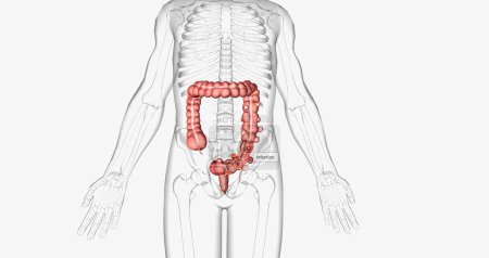 Photo for Diverticulosis occurs when small, bulging pouches develop in your digestive tract. 3D rendering - Royalty Free Image